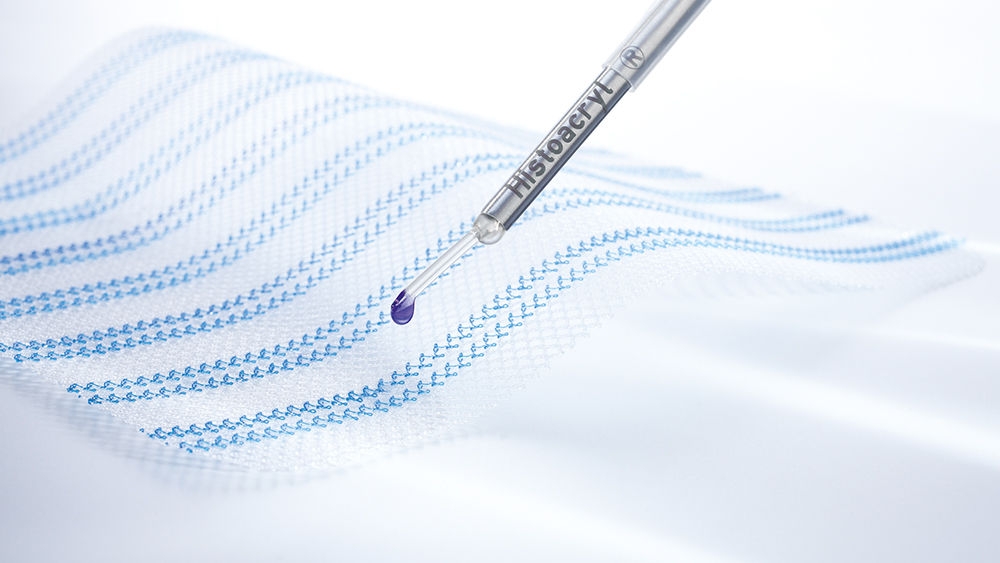 Malla quirúrgica con el aplicador Histoacryl® LapFix para fijar la malla