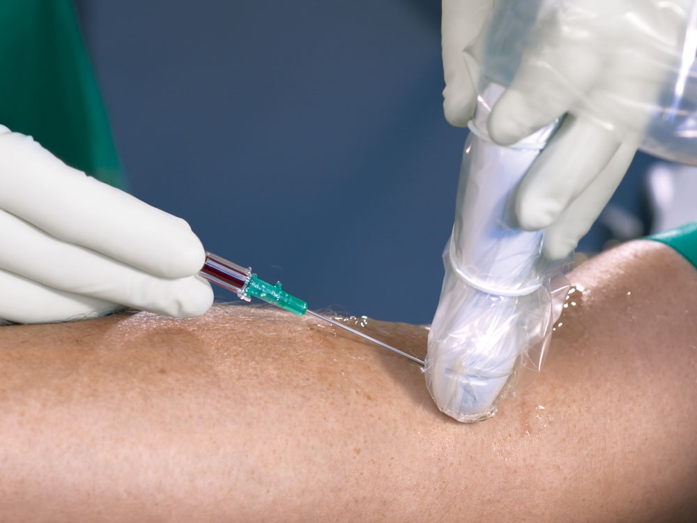 Trabajador sanitario con guantes colocando la cánula de acceso profundo Introcan Safety® bajo verificación por ultrasonidos. La cámara de sangre se llena de sangre.