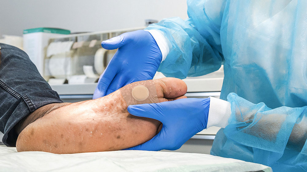 Dos manos con guantes sujetan un pie diabético con un parche sobre él, en el material médico de fondo de una sala médica
